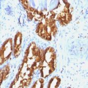 Formalin-fixed, paraffin-embedded human Prostate Carcinoma stained with PSAP Monoclonal Antibody (ACPP/1338).