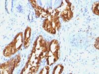 Formalin-fixed, paraffin-embedded human Prostate Carcinoma stained with PSAP Monoclonal Antibody (ACPP/1338).