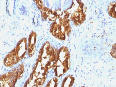 Formalin-fixed, paraffin-embedded human Prostate Carcinoma stained with PSAP Monoclonal Antibody (ACPP/1338).