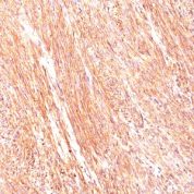Formalin-fixed, paraffin-embedded human GIST stained with Canine1 Monoclonal Antibody (DG1/447).