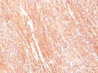 Formalin-fixed, paraffin-embedded human GIST stained with Canine1 Monoclonal Antibody (DG1/447).