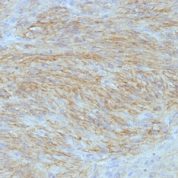 Formalin-fixed, paraffin-embedded human GIST stained with Canine1 Monoclonal Antibody (SPM58).