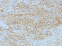 Formalin-fixed, paraffin-embedded human GIST stained with Canine1 Monoclonal Antibody (SPM58).