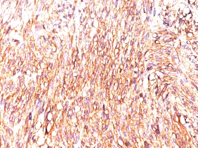 Formalin-fixed, paraffin-embedded human GIST stained with Canine1 Monoclonal Antibody (Canine1.1).