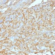 Formalin-fixed, paraffin-embedded human GIST stained with Canine1 Monoclonal Antibody (DG1/447 + Canine1.1).