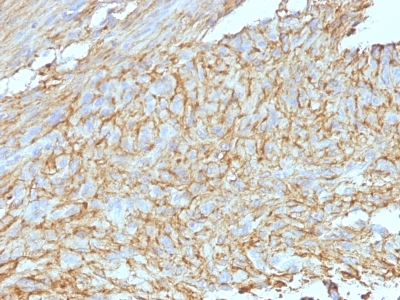 Formalin-fixed, paraffin-embedded human GIST stained with Canine1 Monoclonal Antibody (DG1/447 + Canine1.1).