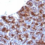 Formalin-fixed, paraffin-embedded Human Colon Carcinoma stained with MAML3 Monoclonal Antibody (MAML3/133).