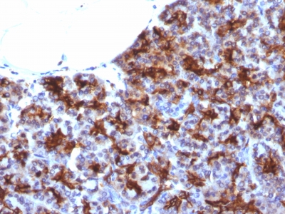 Formalin-fixed, paraffin-embedded Human Colon Carcinoma stained with MAML3 Monoclonal Antibody (MAML3/133).
