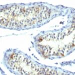 Formalin-fixed, paraffin-embedded human Testicular Carcinoma stained with Prolactin Receptor Monoclonal Antibody (B6.2).