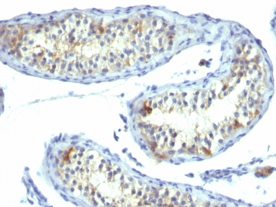 Formalin-fixed, paraffin-embedded human Testicular Carcinoma stained with Prolactin Receptor Monoclonal Antibody (B6.2).