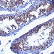 Formalin-fixed, paraffin-embedded human Testicular Carcinoma stained with Prolactin Receptor Monoclonal Antibody (SPM213).