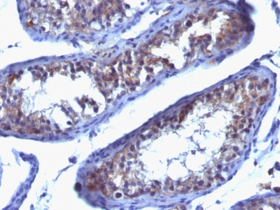 Formalin-fixed, paraffin-embedded human Testicular Carcinoma stained with Prolactin Receptor Monoclonal Antibody (SPM213).