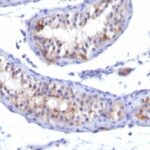 Formalin-fixed, paraffin-embedded human Testicular Carcinoma stained with Prolactin Receptor Monoclonal Antibody (PRLR742).