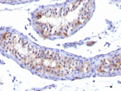 Formalin-fixed, paraffin-embedded human Testicular Carcinoma stained with Prolactin Receptor Monoclonal Antibody (PRLR742).