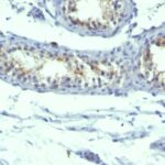 Formalin-fixed, paraffin-embedded human Testicular Carcinoma stained with Prolactin Receptor Monoclonal Antibody (B6.2 + PRLR742).