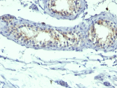 Formalin-fixed, paraffin-embedded human Testicular Carcinoma stained with Prolactin Receptor Monoclonal Antibody (B6.2 + PRLR742).