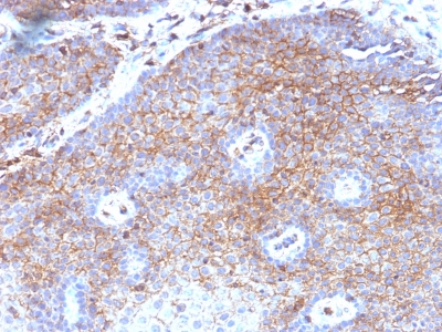 Formalin-fixed, paraffin-embedded human Endometrial Carcinoma stained with Beta-2-Microglobulin Monoclonal Antibody (B2M/1118)