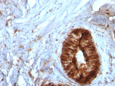 Formalin-fixed, paraffin-embedded human Melanoma stained with Beta-2-Microglobulin Monoclonal Antibody (B2M/961).