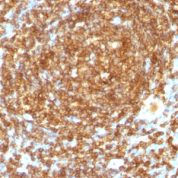 Formalin-fixed, paraffin-embedded human Lymphoma stained with CD45RB Monoclonal Antibody (PTPRC/1132).