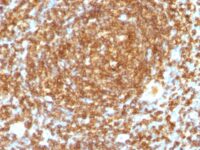 Formalin-fixed, paraffin-embedded human Lymphoma stained with CD45RB Monoclonal Antibody (PTPRC/1132).