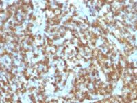 Formalin-fixed, paraffin-embedded human Lymphoma stained with CD45RO Monoclonal Antibody (SPM125).