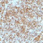 Formalin-fixed, paraffin-embedded human Lymphoma stained with CD45RB Monoclonal Antibody (SPM569).