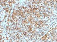 Formalin-fixed, paraffin-embedded human Lymphoma stained with CD45RB Monoclonal Antibody (SPM569).