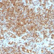 Formalin-fixed, paraffin-embedded human Lymphoma stained with CD45 Monoclonal Antibody (SPM569+SPM57).