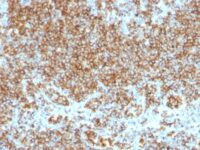 Formalin-fixed, paraffin-embedded human Lymphoma stained with CD45 Monoclonal Antibody (SPM569+SPM57).