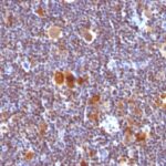 FFPE human Hodgkin's Lymphoma labeled with Anti-human Bax Monoclonal Antibody (Clone SPM336). Antigen retrieval in TE buffer (pH 9.0).