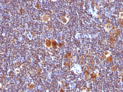 FFPE human Hodgkin's Lymphoma labeled with Anti-human Bax Monoclonal Antibody (Clone SPM336). Antigen retrieval in TE buffer (pH 9.0).