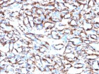 Formalin-fixed, paraffin-embedded human Leiomyosarcoma stained with Smooth Muscle Actin Monoclonal Antibody (ACTA2/791).