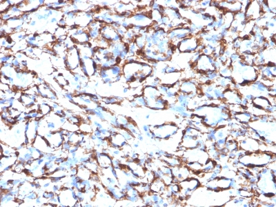 Formalin-fixed, paraffin-embedded human Leiomyosarcoma stained with Smooth Muscle Actin Monoclonal Antibody (ACTA2/791).