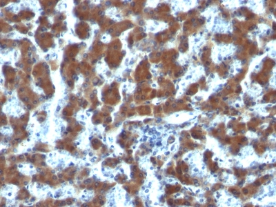 Formalin-fixed, paraffin-embedded human Hepatocellular Carcinoma stained with RBP1 (G4E4)