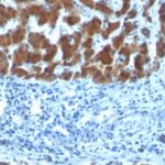 Formalin-fixed, paraffin-embedded human Hepatocellular Carcinoma stained with RBP1 (SPM442)