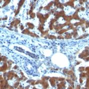 Formalin-fixed, paraffin-embedded human Ovarian Carcinoma stained with RBP1 (RBP/872)