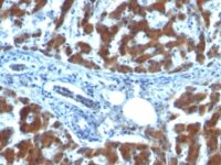 Formalin-fixed, paraffin-embedded human Ovarian Carcinoma stained with RBP1 (RBP/872)