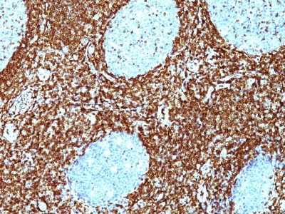 Staining with Mouse Monoclonal BCL-2 [100 D5 + 124] Antibody in formalin-fixed paraffin-embedded human non-Hodgkins Lymphoma. Note cytoplasmic and nuclear membrane staining.