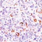 Formalin-fixed, paraffin-embedded human Hodgkin's Lymphoma stained with Bcl-x Monoclonal Antibody (SPM337).
