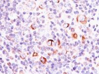 Formalin-fixed, paraffin-embedded human Hodgkin's Lymphoma stained with Bcl-x Monoclonal Antibody (SPM337).