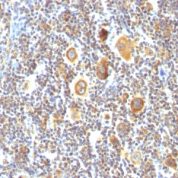 Formalin-fixed, paraffin-embedded human Hodgkin's Lymphoma stained with bcl-6 Monoclonal Antibody (BCL6/85).