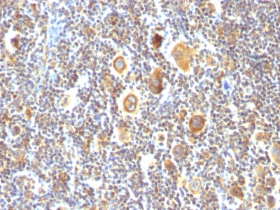 Formalin-fixed, paraffin-embedded human Hodgkin's Lymphoma stained with bcl-6 Monoclonal Antibody (BCL6/85).