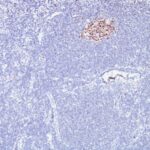 Formalin-fixed, paraffin-embedded human Lymphoma stained with bcl-6 Monoclonal Antibody (SPM62).