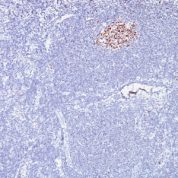 Formalin-fixed, paraffin-embedded human Lymphoma stained with bcl-6 Monoclonal Antibody (SPM62).