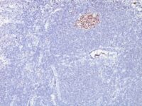 Formalin-fixed, paraffin-embedded human Lymphoma stained with bcl-6 Monoclonal Antibody (SPM62).