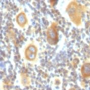 Formalin-fixed, paraffin-embedded human Hodgkin's Lymphoma stained with bcl-6 Monoclonal Antibody (PG-B6P).