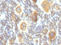 Formalin-fixed, paraffin-embedded human Hodgkin's Lymphoma stained with bcl-6 Monoclonal Antibody (PG-B6P).