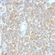 Formalin-fixed, paraffin-embedded human Melanoma stained with bcl-6 Monoclonal Antibody (SPM363).