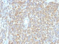 Formalin-fixed, paraffin-embedded human Melanoma stained with bcl-6 Monoclonal Antibody (SPM363).