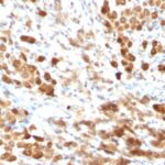 Formalin-fixed, paraffin-embedded human Melanoma stained with S1B Mouse Monoclonal Antibody (SPM354).